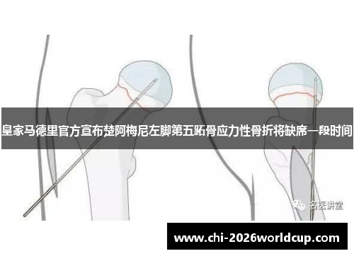 皇家马德里官方宣布楚阿梅尼左脚第五跖骨应力性骨折将缺席一段时间